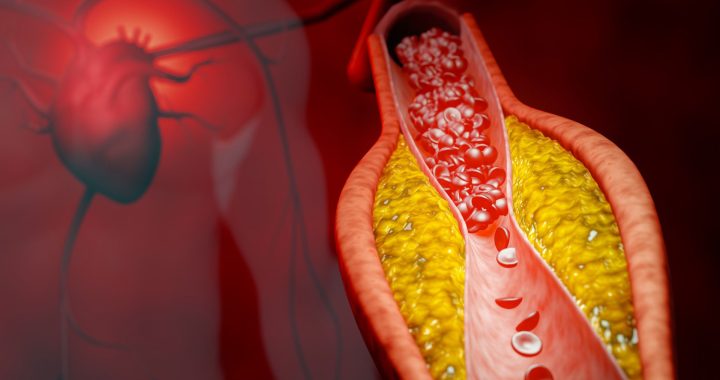 PREVENT ASCVD Calculator: 10- & 30-Year Heart Risk